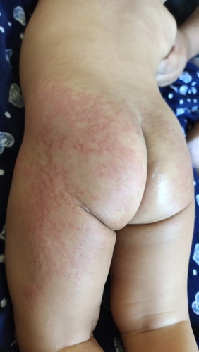 Sino po same case ni lo dito 8 days na po ito naka tatlong pa check up na po kame 🥺😭😭