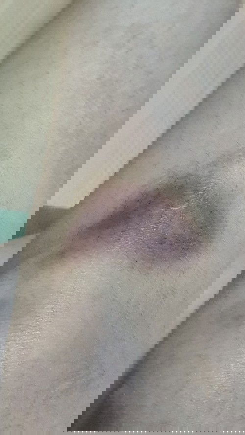 ท้องได้ 3 เดือนเดินแล้วล้มค่ะ