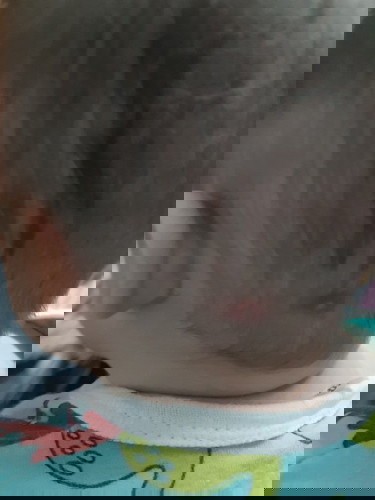 มีตุ๋มหนองขึ้น