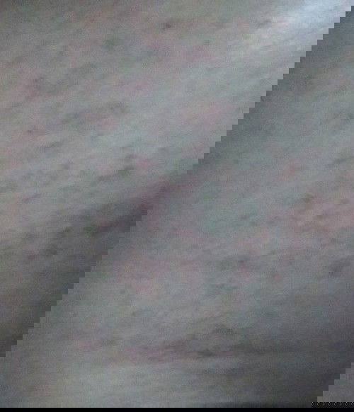 Gatel di bagian perut kiri dan kanan