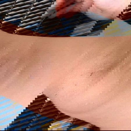 ลูกเป็นผื่นทายาตัวไหนดี