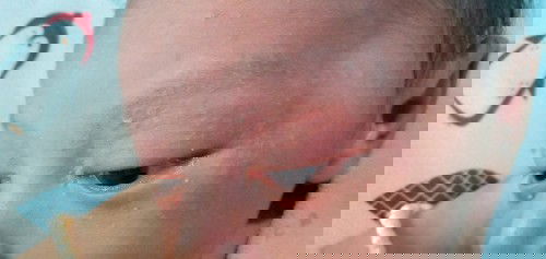 ALERGI ATAU BIANG KERINGAT?