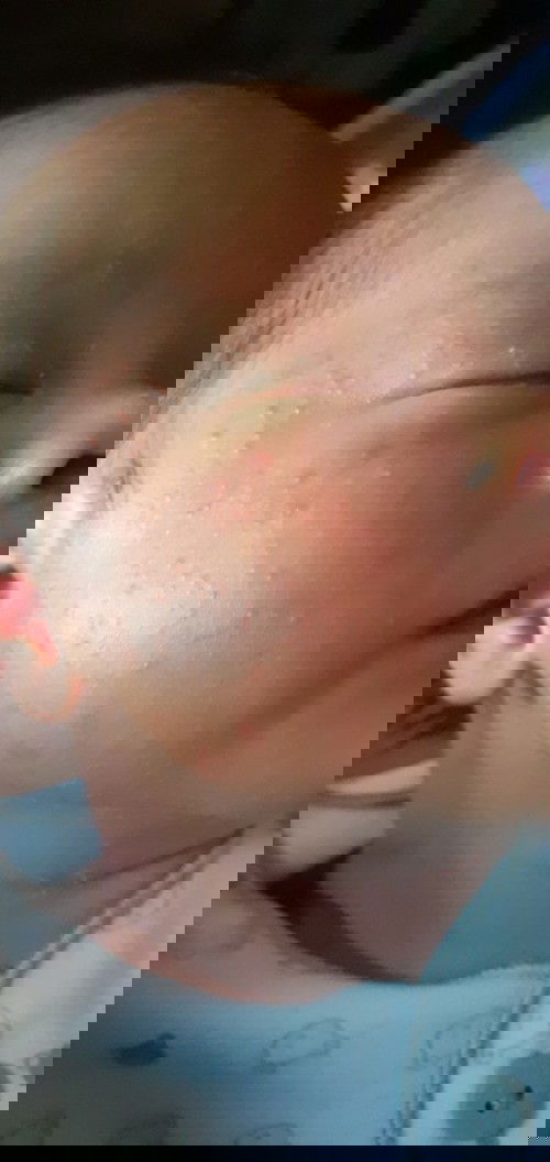 Bruntusan di muka baby