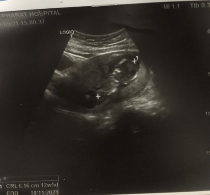 13 wks. มีเลือดออก