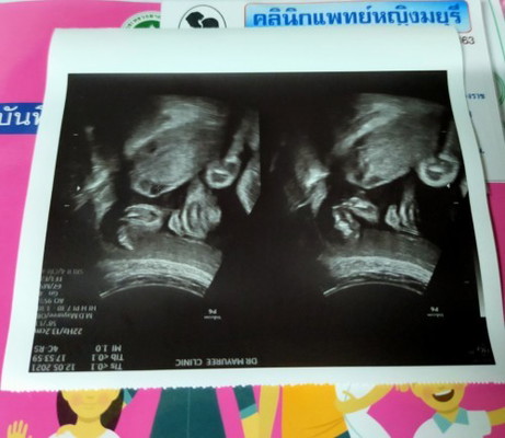 28w6d แล้ว