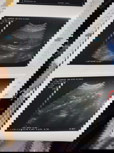 อัลตร้าซาวได้ลูกผู้ชาย