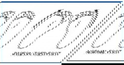 Intoed pd balita usia 4th