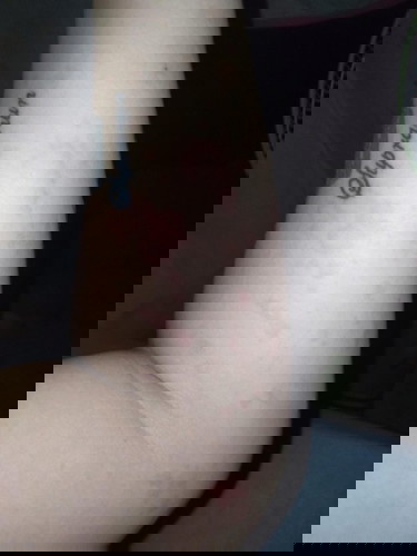 ตอนนี้ท้องได้6เดือนกว่ามีผื่นคันขึ้น