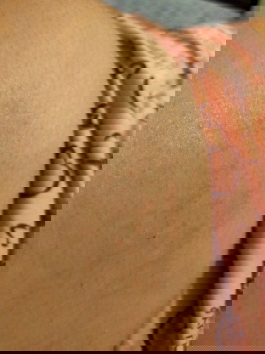 ท้องแม่เป็นผื่น