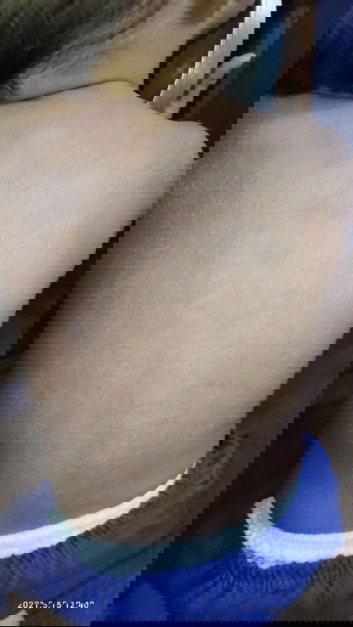 RASHES AND FORMULA MILK