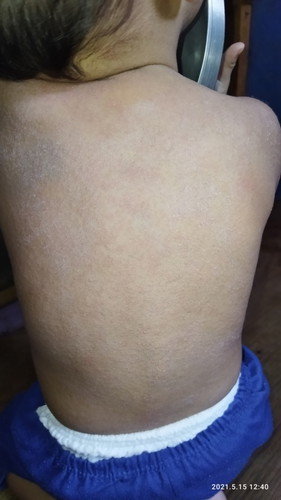 RASHES AND FORMULA MILK