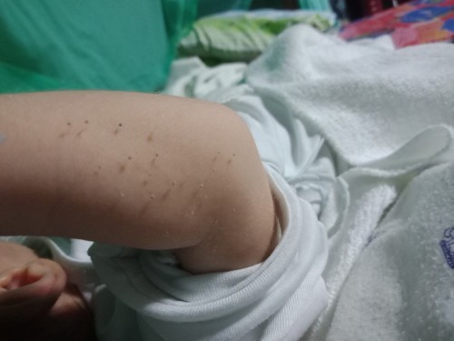 anu po kaya itong sa braso ni baby.woried lang po ako😢