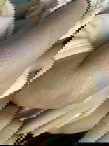 ผิวลูกน้อยลอกทั่วแขนขาเลย