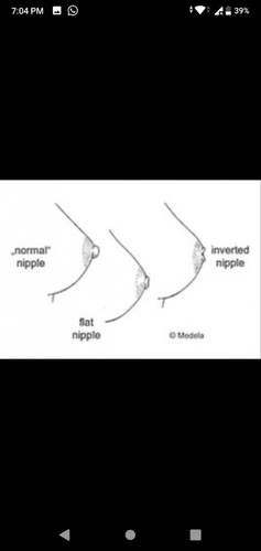 share pengalaman ibu yang ada Masalah puting tenggelam/INVERTED NIPPLE