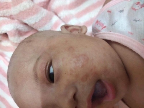 ผื่นแห้งๆที่หน้าลูก