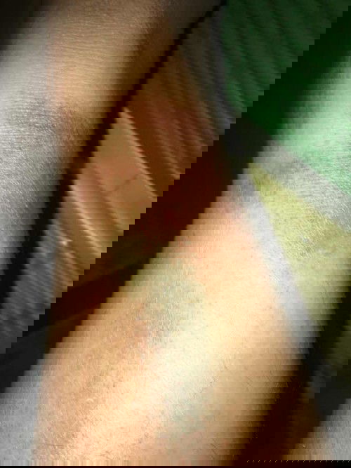 dry skin or ano pa man