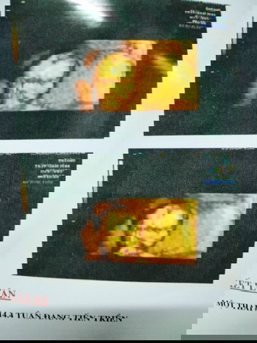 14w đc 85g v có nhẹ k các m.3tháng đầu ăn tốt lắm nhưng giờ lại chán ăn. Có m n như e k