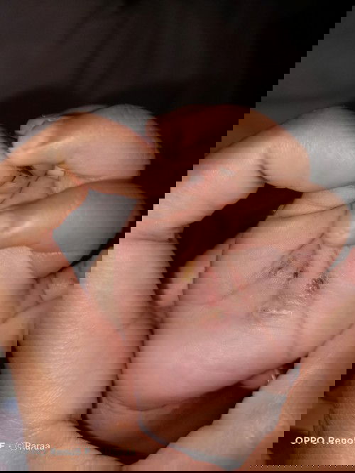 Gatal bernanah dan berair