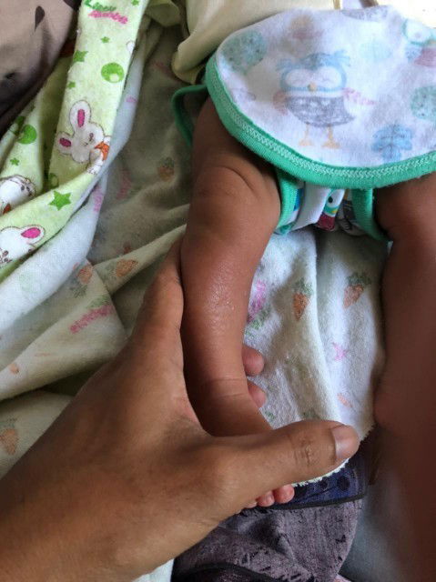 Kaki bayi bengkok