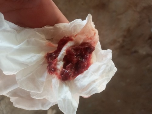 น้ำคาวปลายังไม่หมดแต่ออกไม่เยอะ