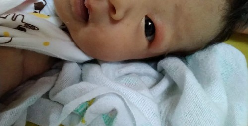 ลูกโดนยุงกัดที่ตา บวมเเดงต้องทำไงค่ะ ลูกพึ่งได้ 21 วัน