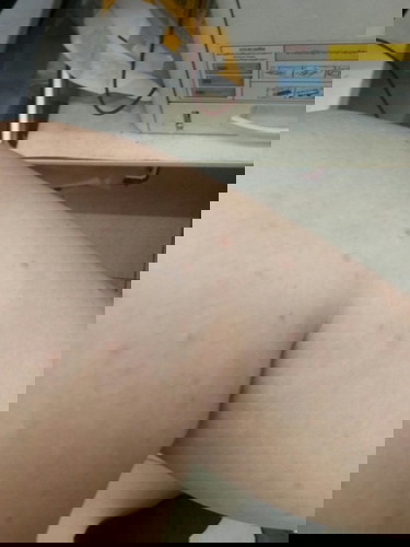 เปนผื่นค่ะ