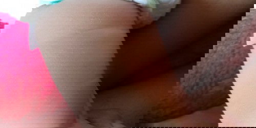 Bintik putih di kulit paha