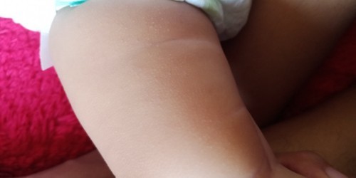 Bintik putih di kulit paha