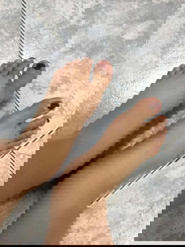 อาการเท้าบวม 36 w