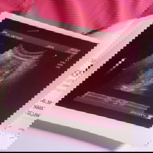 Keluar flek di usia 5week