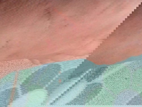 มีผดผื่นขึ้นที่เท้าเเละมือแม่ๆคนไหนพอจะรู้บ้างว่าเกิดจากอะไร