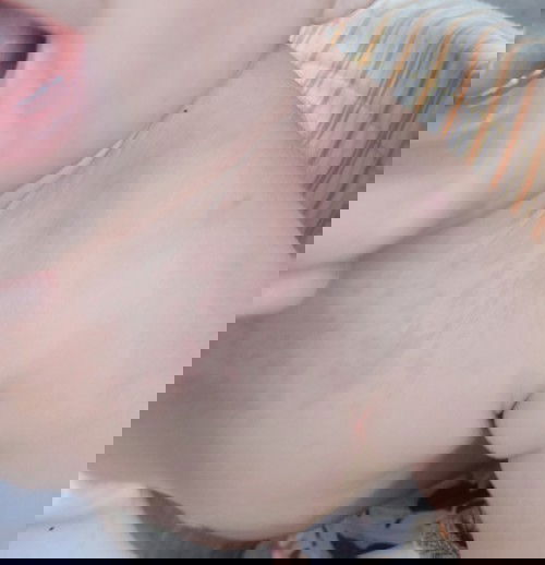 ผื่นเเดงที่คอ