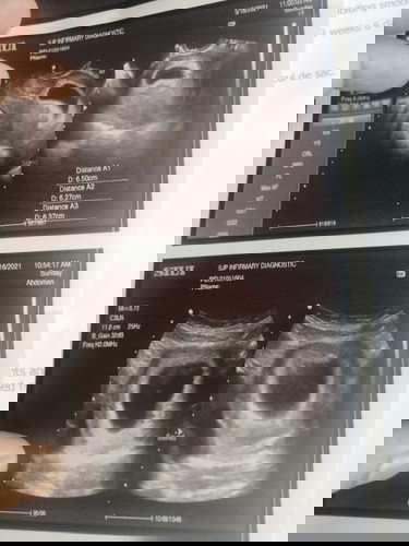 Early pregnancy vs blighted ovum