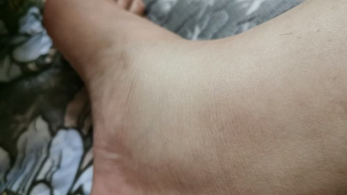 Kaki bengkak diawal pregnant normal ka? Ia terjdi slepas mkan laksa?? Sebb ni 1st pregnant sya? Tlg?