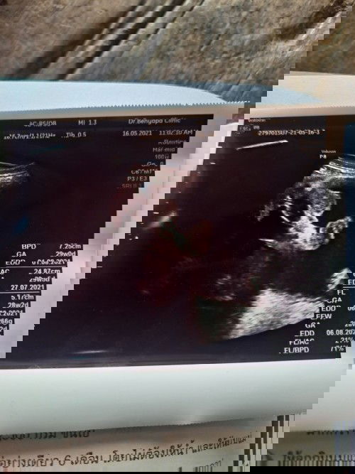 28 สัปดาห์ คุณหมอบอกว่า น้ำคร่ำเยอะ ไม่ดี ตอนนี้กังวลมากเลยยค่ะ (ลูกจะเป็นอะไรไหม?)