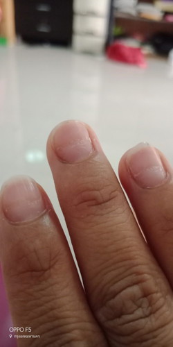 เล็บขึ้นใหม่