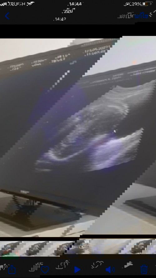 เสี่ยงคลอดก่อนกำหนด33+4w