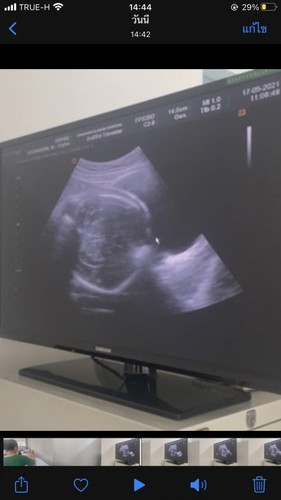 เสี่ยงคลอดก่อนกำหนด33+4w