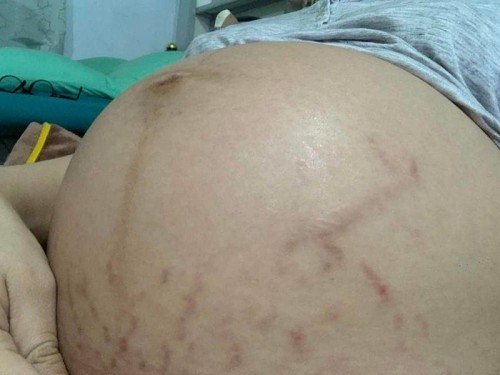 ท้องแตกเยอะมาก😩แม่ๆบ้านไหนแตกบ้างค่ะ😩