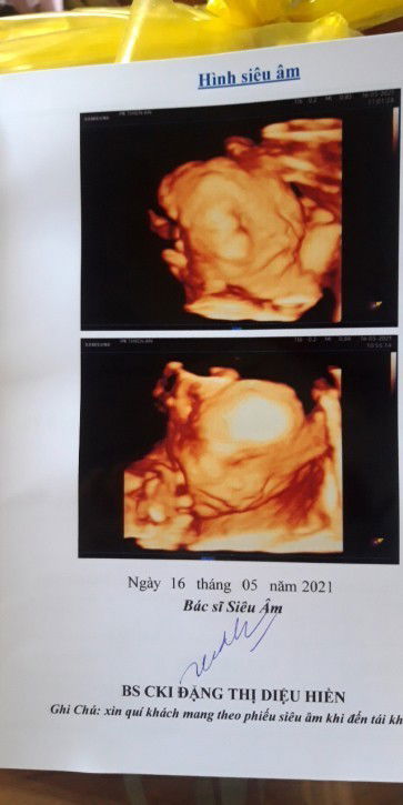 Các mom ơi ,có mom nào tiêm ngừa uốn ván về .Mà thấy con ít đạp k ạ .Sao e lo quá .