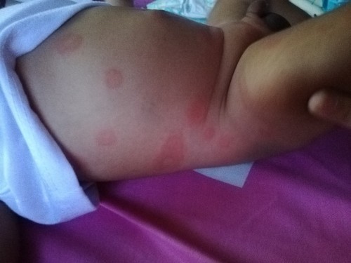 Eczema po ba to?