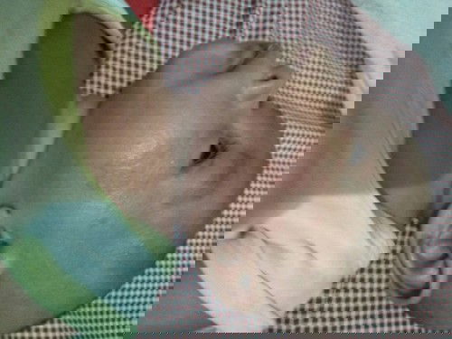 Ruam susu dan merah merah diwajah