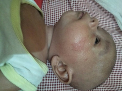 Ruam susu dan merah merah diwajah