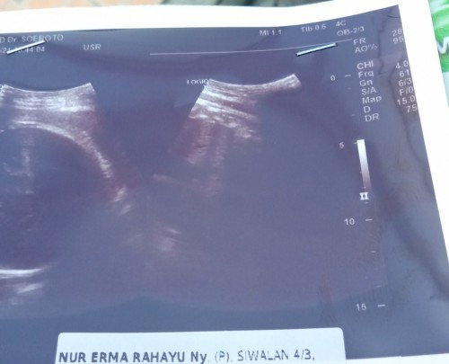 Hasil USG 32-33week
