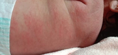 Biang keringat dan kemerahan