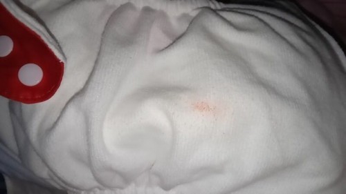 stain ng dugo