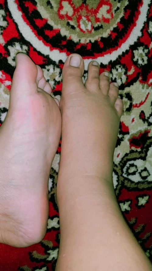 Kaki bengkak