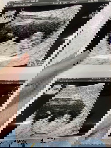 มีซาวอีกตอนกี่เดือนคะ ซาวรอบแรกดูเพศไปตอน5เดือน