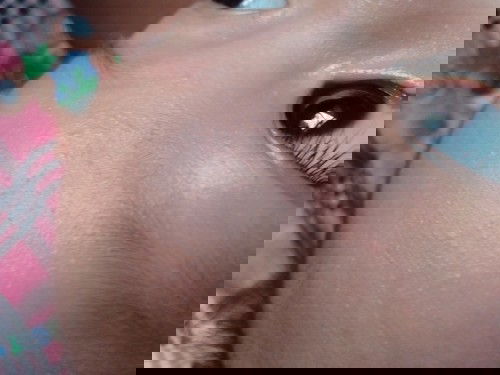 มันตุ่มอะไรคะแม่ เป็นตุ่มใสเล็กๆแต่ขึ้นในหน้าน้อง มีแม่ไหนรู้บ้างคะ