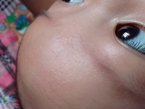 มันตุ่มอะไรคะแม่ เป็นตุ่มใสเล็กๆแต่ขึ้นในหน้าน้อง มีแม่ไหนรู้บ้างคะ